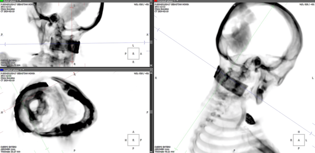 Nazca Mummies (VIDEO): Tridactyl humanoid specimen "Sebastian" | CT-scan cervical spine, metal implant (complete set)