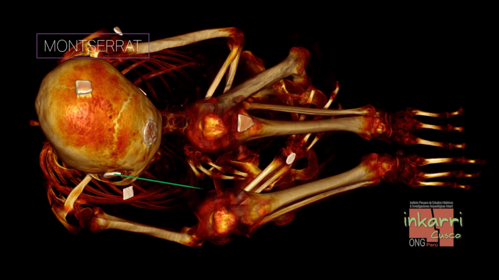 Nazca Mummies (VIDEO): Inkari Institute publishes another CT-scan of "Montserrat" showing details of her metal implants