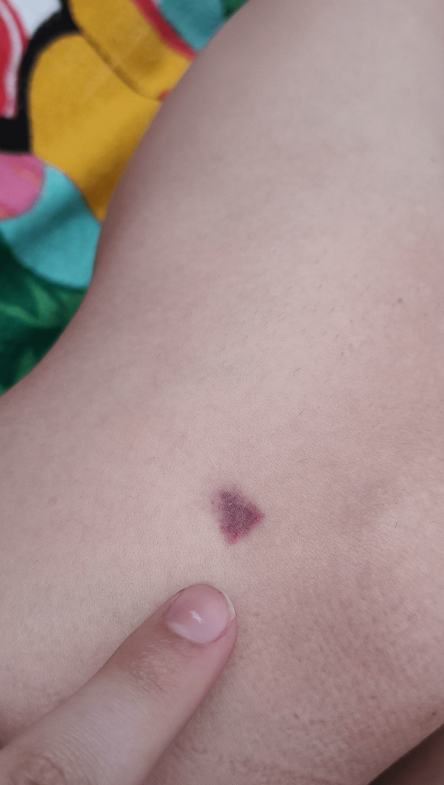 This triangle bruise keeps appearing in the same exact spot on my knee