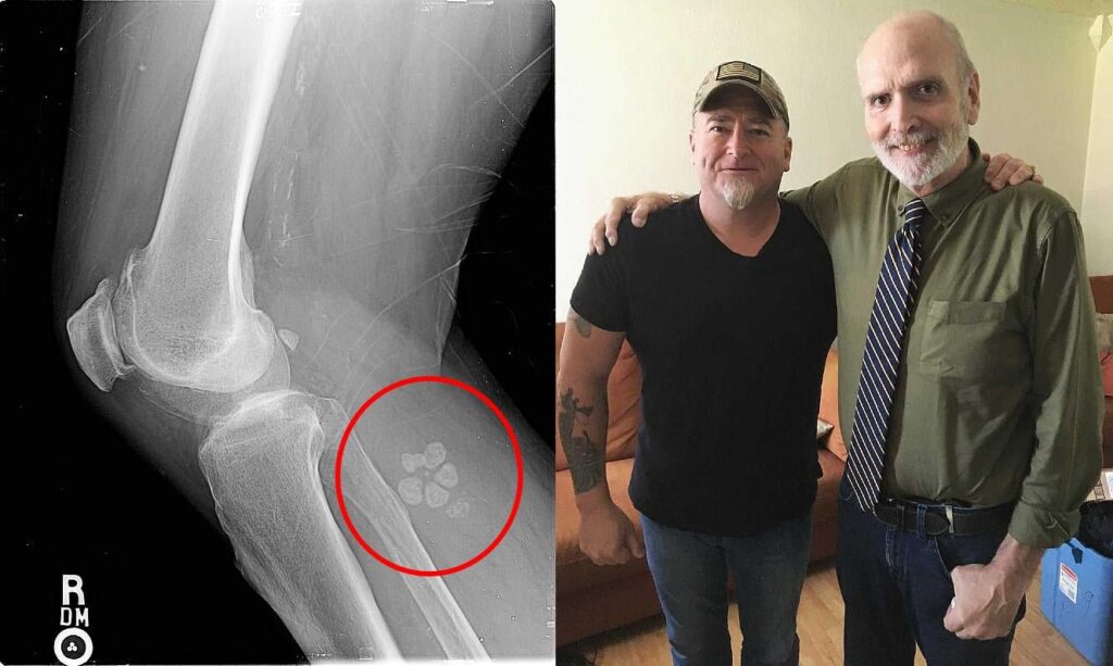 Terry lovelace’s Alien implant discovered during a 2012 X-ray which resurfaced memories of abduction during his military service in 1970s. The object in his leg remained there until it was mysteriously removed after a visit from a “Women in black” which new x-rays prove it’s no longer there. Terry lovelace's Alien implant discovered during a 2012 X-ray which resurfaced memories of abduction during his military service in 1970s. The object in his leg remained there until it was mysteriously removed after a visit from a "Women in black" which new x-rays prove it's no longer there.