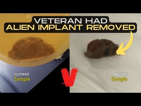 Exclusive Interview w/ Veteran Who Had Alien Implant Removed