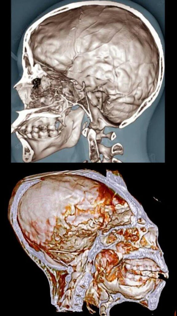 Side view comparison of a human skull and a tridactyl skull