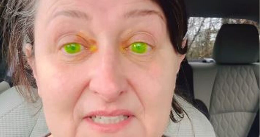 Mum’s eyes turn fluorescent ‘alien’ green after shocking Galway hospital accident Irish Mirror