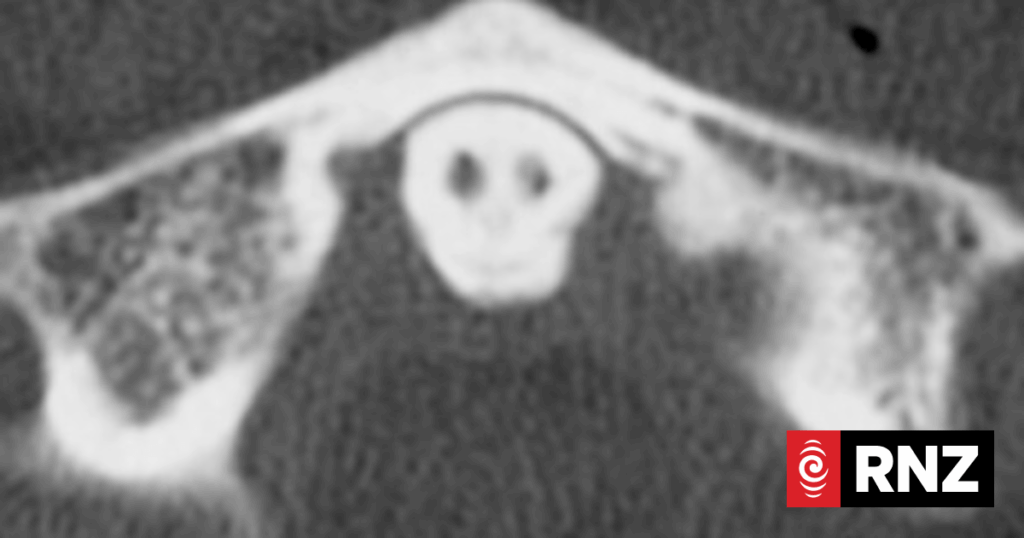 Spooky 'grim reaper' image shows up on medical scan of car crash victim