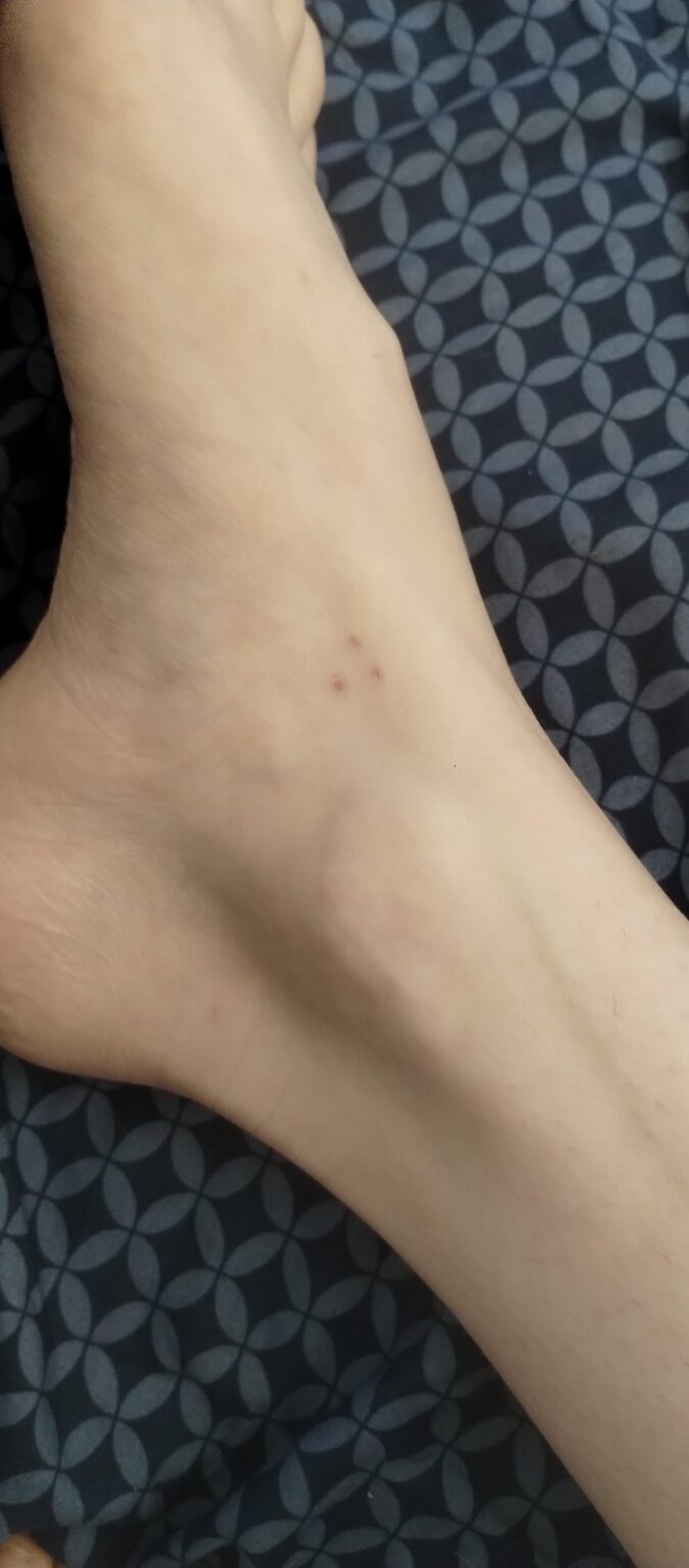 Triangular marks that weren't there the night before. Anyone else? Please hear me out.
