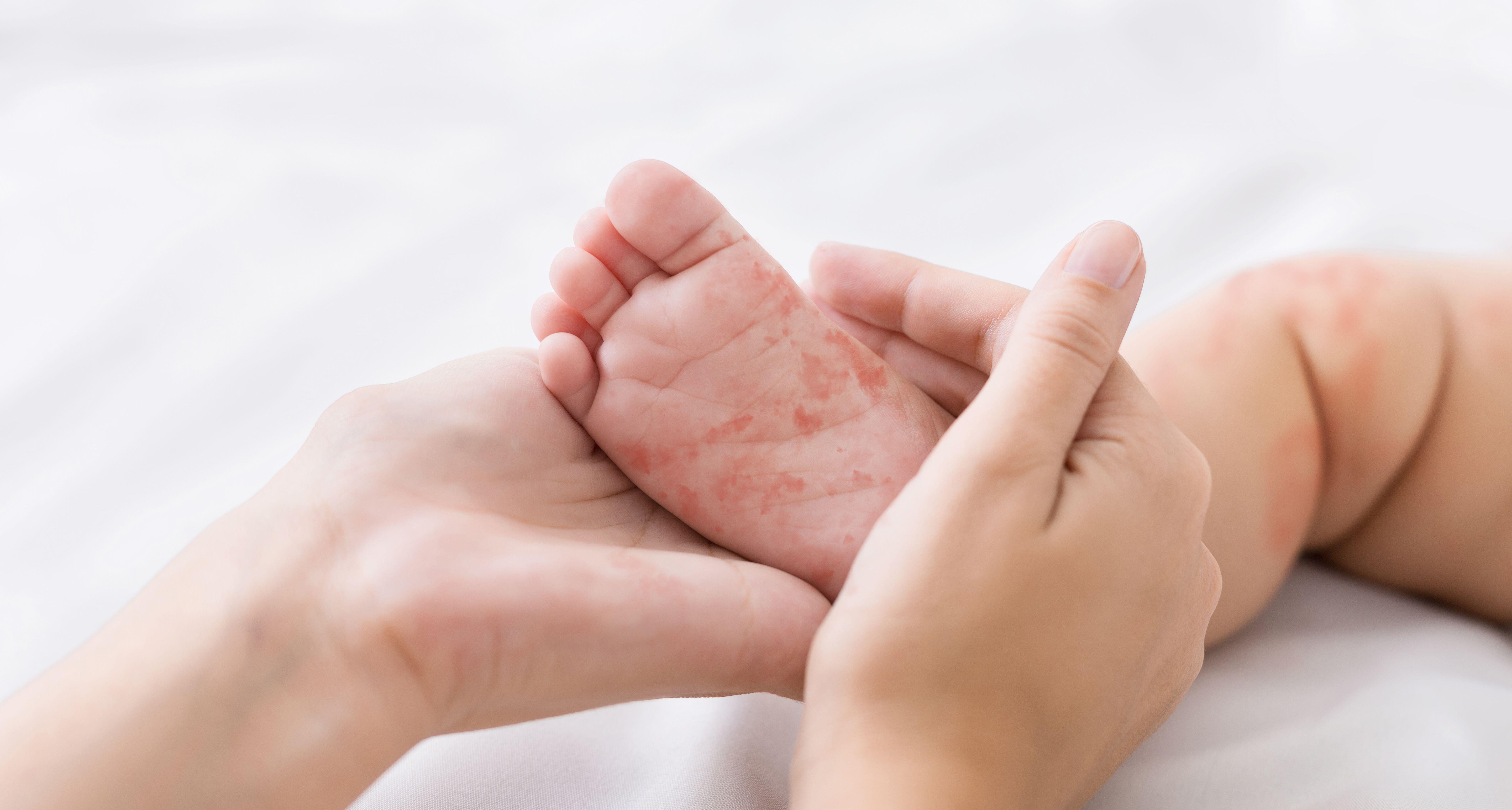 Mother holding tiny baby foot with measles rash