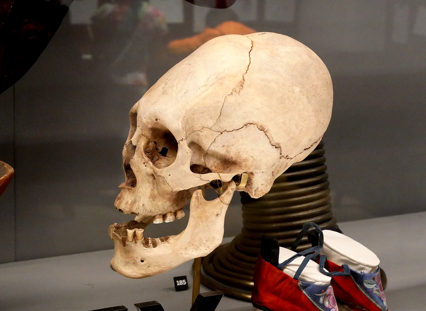 An example of ancient skull shaping (elongated skull)
