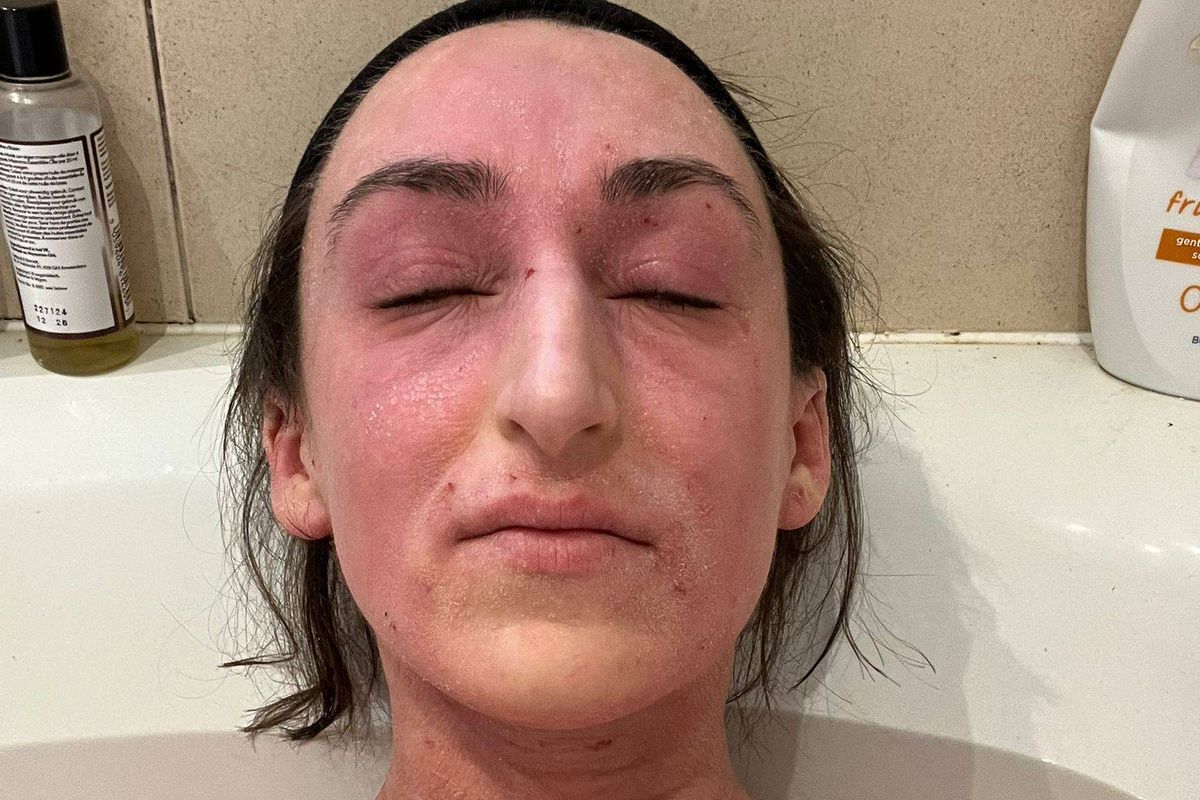 Rosemary in bath showing dry skin