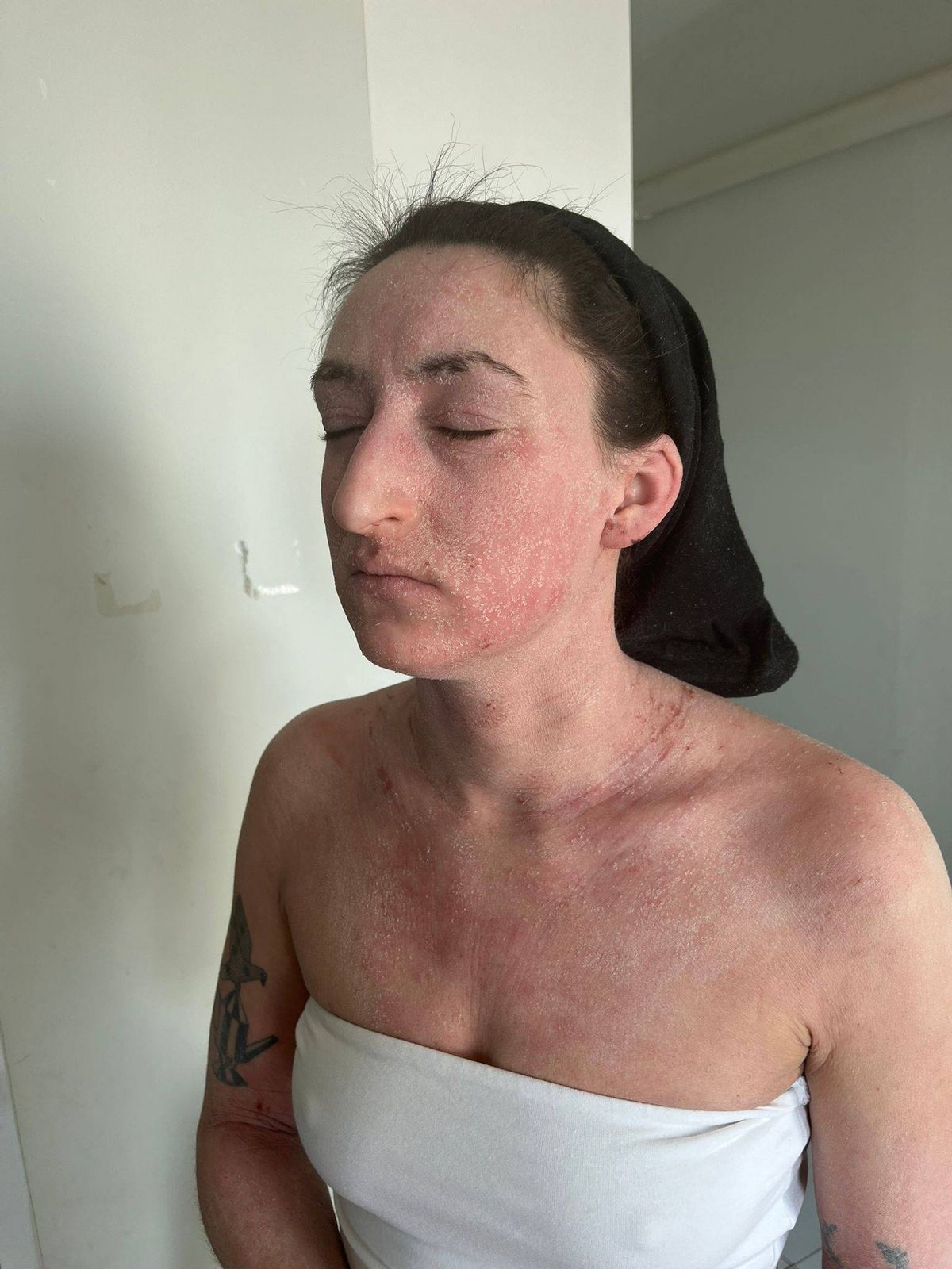 Rosemary showing her skin