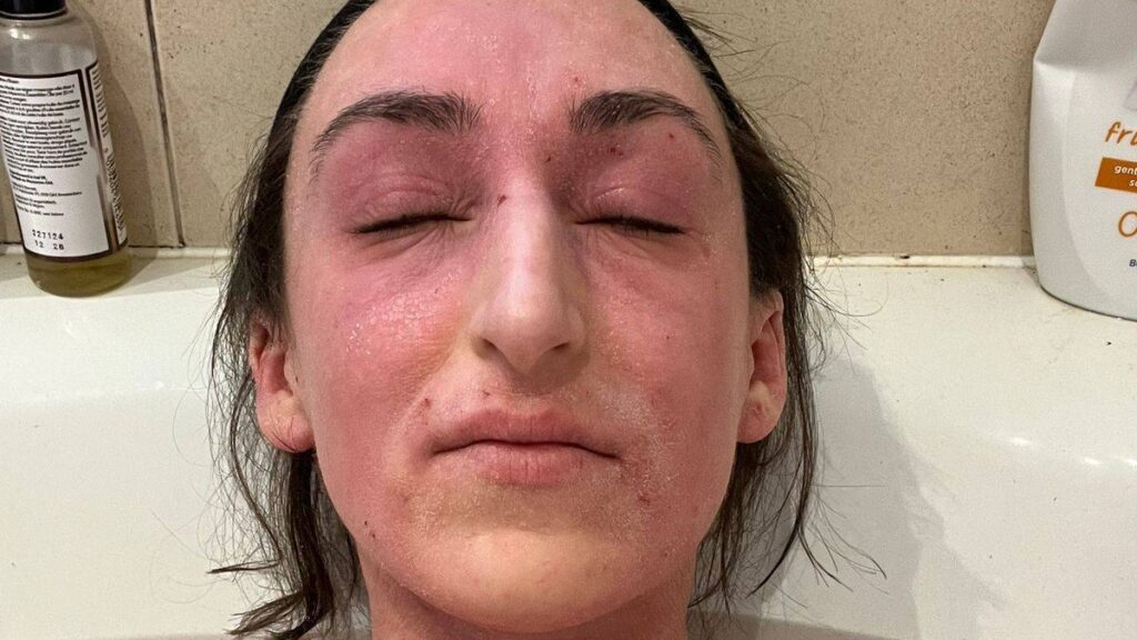 ‘I used cream for 28 years and it left me with alien skin’ Daily Mirror