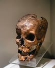 The Myth of Midas vs. Biological Reality: The 2,700-year-old skull of the King shows the "Donkey Ears" were likely a birth defect.